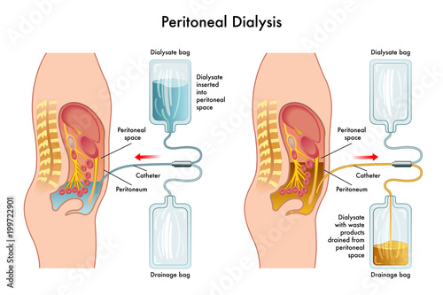 vector medical illustration of  procedure of peritoneal dialysis