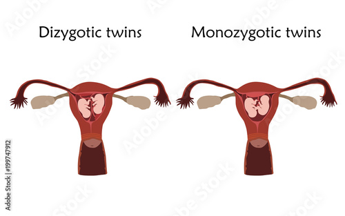Multiple pregnancy. Dizygotic and monozygotic twins, embryo, fetus in uterus, placenta, umbilical cord. Vector flat medical illustration. Colored image, white background.