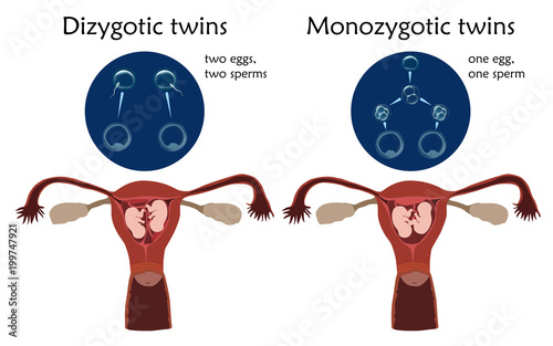 Multiple pregnancy. Dizygotic and monozygotic twins, embryo, fetus in uterus, placenta, umbilical cord, egg, sperm. Vector flat medical illustration. Colored image, white background.