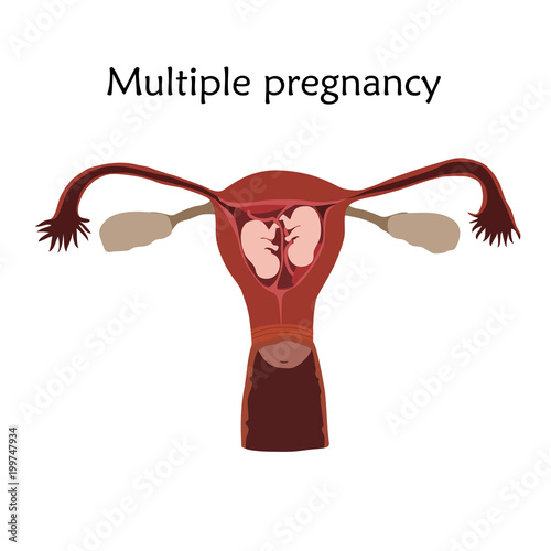 Multiple pregnancy, twins, embryo, fetus in uterus, placenta, umbilical cord. Vector flat medical illustration. Colored image, white background.