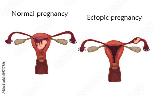 Ectopic and normal pregnancy. The fetus, uterus, womb. Anatomy flat illustration. White background.