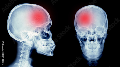hemorrhage stroke