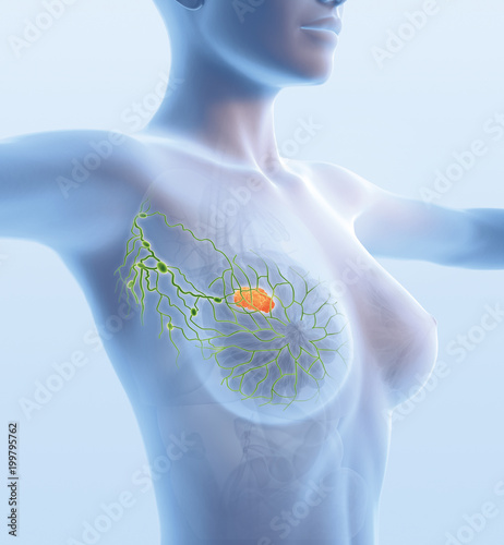 Breast cancer, lymphatics, mastocarcinoma, sentinel lymph node, medical illustration