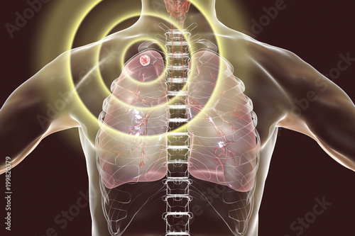 Tuberculosis treatment and prevention concept, 3D illustration showing secondary tuberculosis in lungs, apical nodule photo