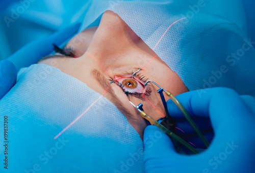 Laser vision correction. A patient and team of surgeons in the operating room during ophthalmic surgery. Eyelid speculum. Lasik treatment. photo