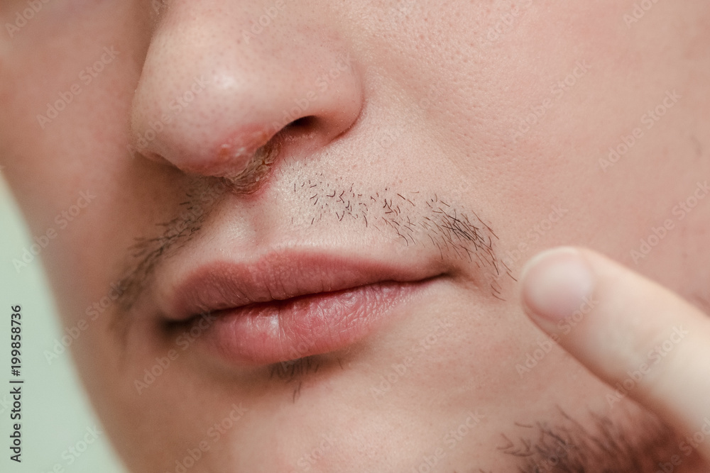 Herpes on lips of the young man. Shocked man touching pain her nose. Inflammation of the lip. Beauty concept. Man nose infected herpes virus. Man smears herpes with herpes cream. Herpes on lips of the young man. Shocked man touching pain her nose. Inflammation of the lip. Beauty concept. Man nose infected herpes virus. Man smears herpes with herpes cream.