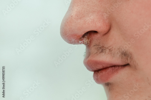 Herpes on nose of the young man. Inflammation of the lip. Beauty concept. Lips and nose infected herpes virus. Man with herpes virus. Cold sore on nose.