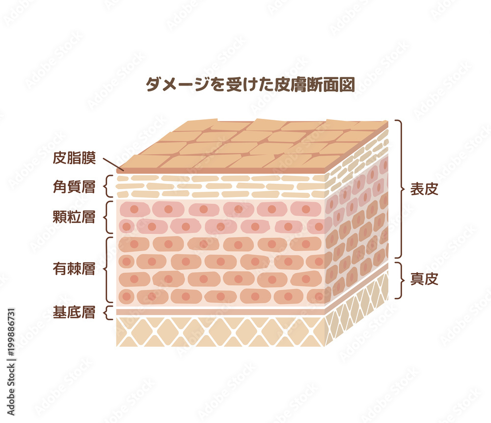 ダメージを受けた人体皮膚 肌荒れ の断面図イラスト 文字あり Stock Vector Adobe Stock