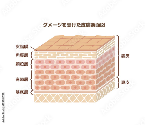 ダメージを受けた人体皮膚（肌荒れ)の断面図イラスト (文字あり)