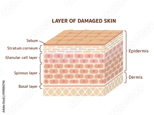 Layer of damaged skin illustration