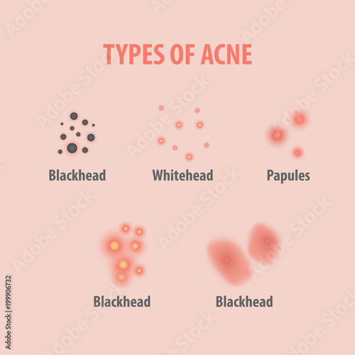 Types of acne illustration vector on white background, Beauty concept.