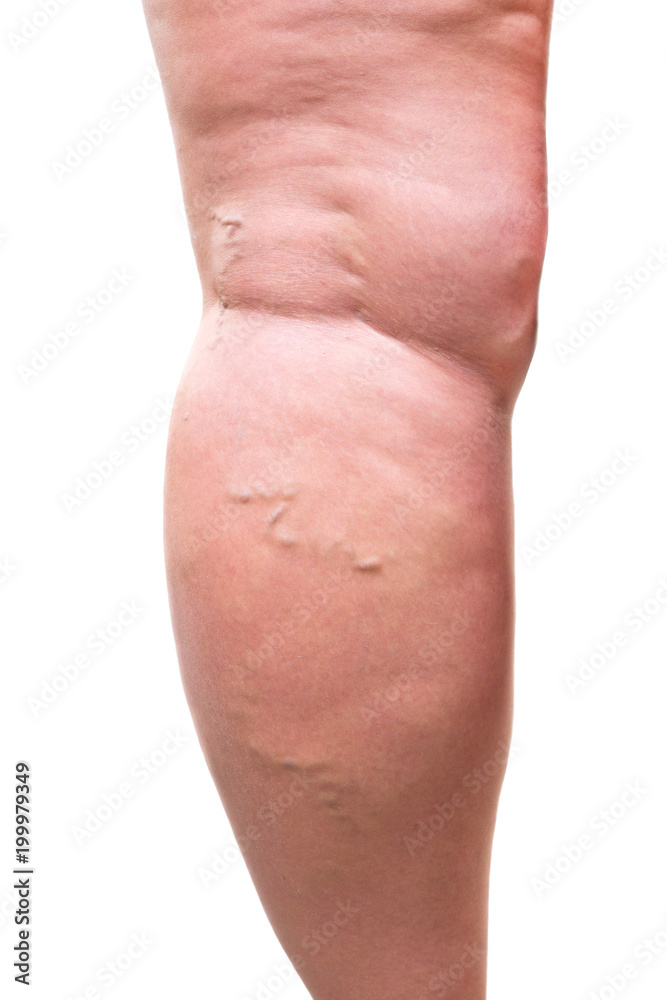 Varicose veins closeup, fat female legs Varicose veins closeup, fat female legs