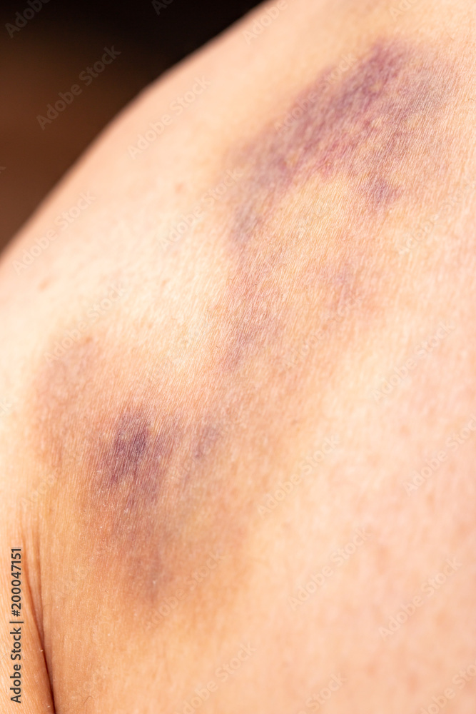 bruise on the skin bruise on the skin