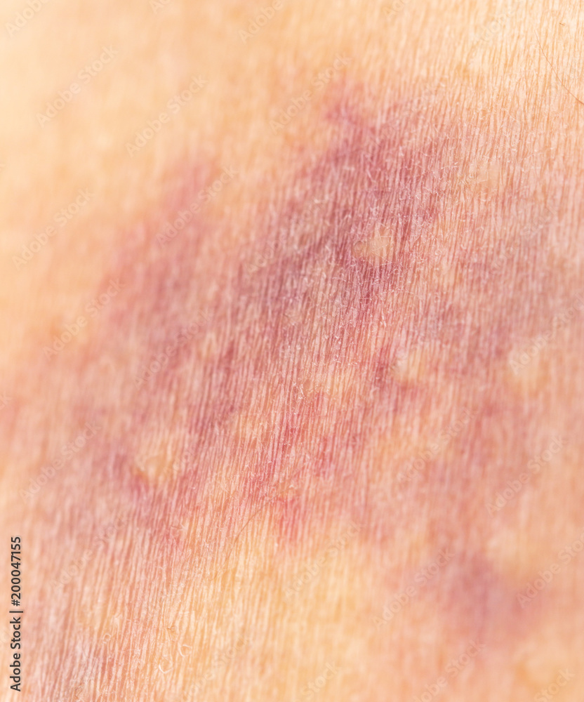 Fototapeta premium bruise on the skin