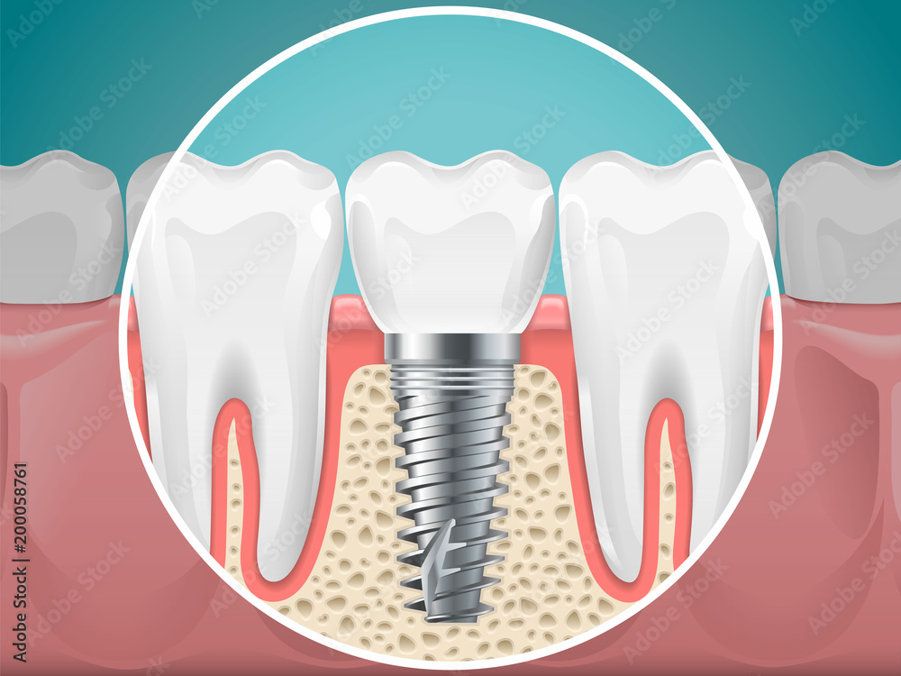 Stomatology illustrations. Dental implants and healthy teeth Stomatology illustrations. Dental implants and healthy teeth
