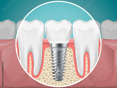 Stomatology illustrations. Dental implants and healthy teeth photo
