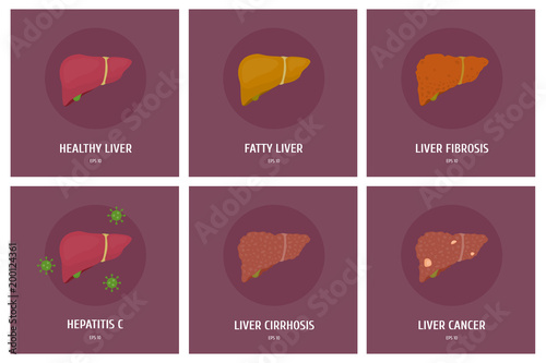 A set of healthy liver and its various diseases: hepatitis, cancer, obesity, cirrhosis. Vector flat illustration photo