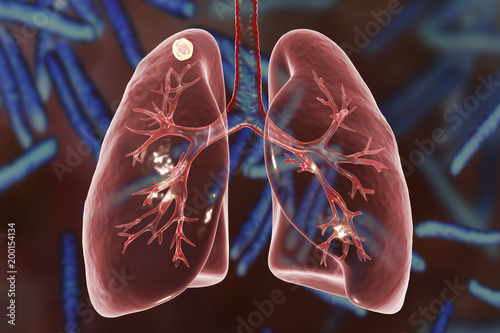 Secondary tuberculosis in lungs, apical nodule, 3D illustration photo