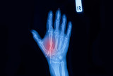 X-ray image of hand from a human body part show bone fracture with implants