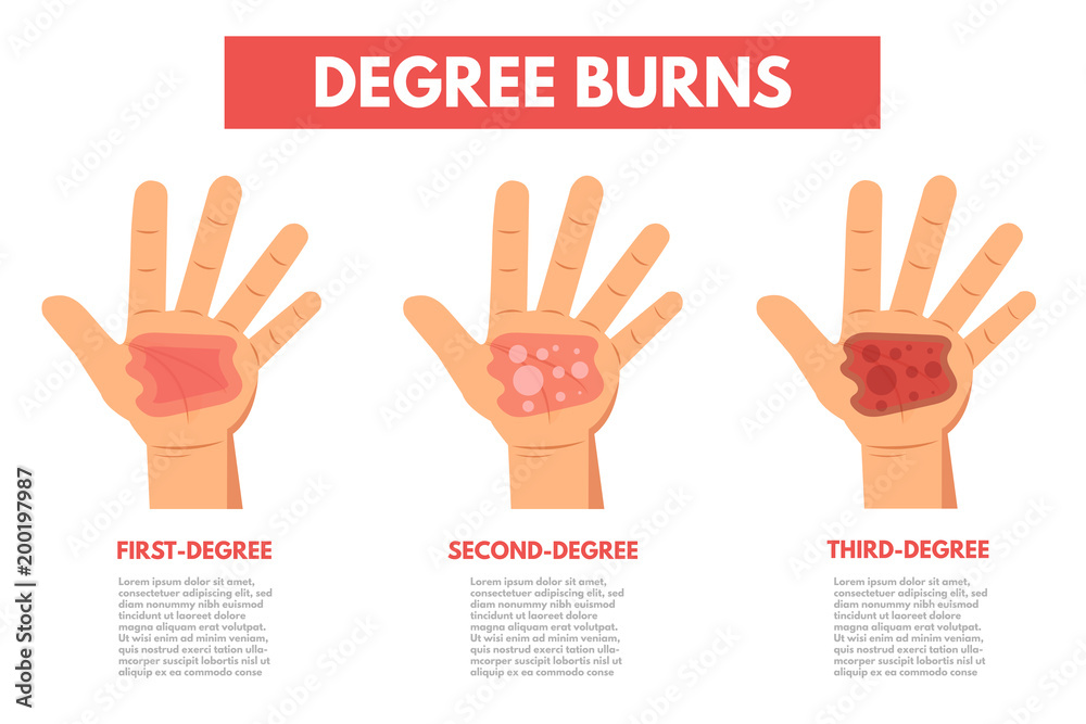 © Andrii Symonenko - Degree burns of skin. Infographic Vector illustration.