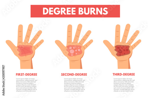 Degree burns of skin. Infographic Vector illustration. photo