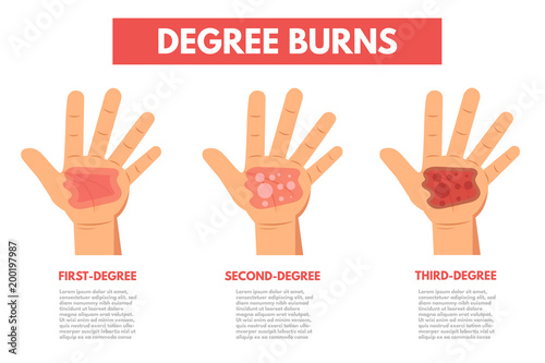 Degree burns of skin. Infographic Vector illustration.