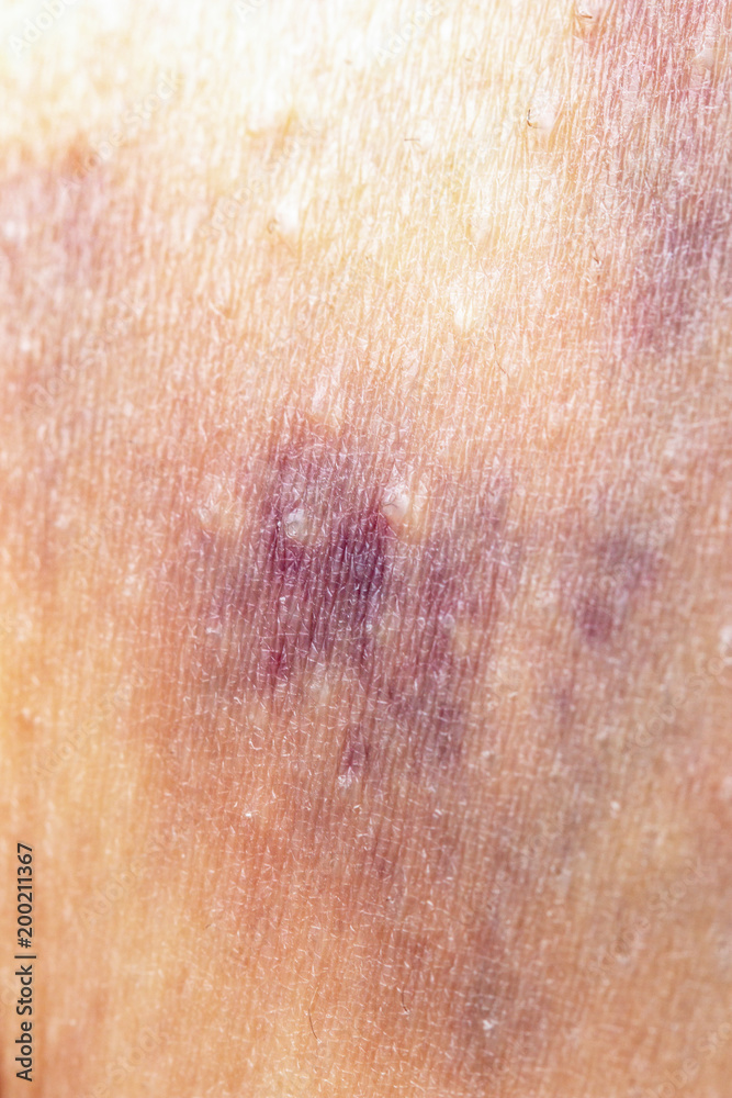 bruise on the skin