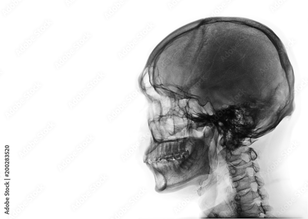 X-ray image of side view asian skull black and white