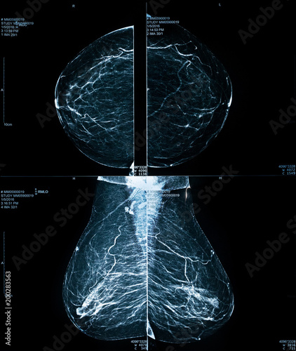 Mammogram / Mammography xray image for breast cancer prevention and diagnosis. Medical technology concept.