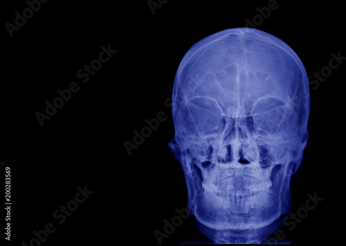 X-ray image of front view asian skull and blank area at left side
