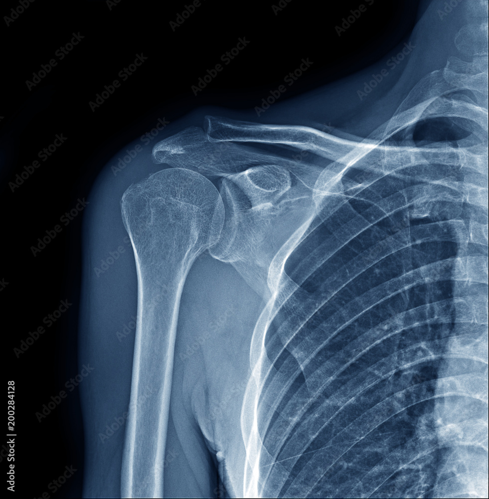 X-ray of right human shoulder joint show humerus, scapular, clavicle, lips, lung and part of heart. X-ray of right human shoulder joint show humerus, scapular, clavicle, lips, lung and part of heart.