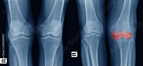 X-ray image show comparison of older normal knee on left side and osteoarthritis knee on right side front view. area of deformity with red color mark. photo