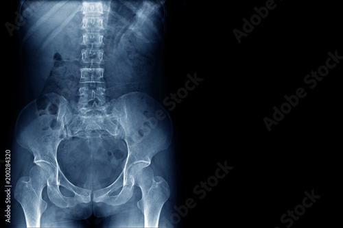 x-ray image of human normal spine, rips, pelvis, both hip joint and blank area at right side