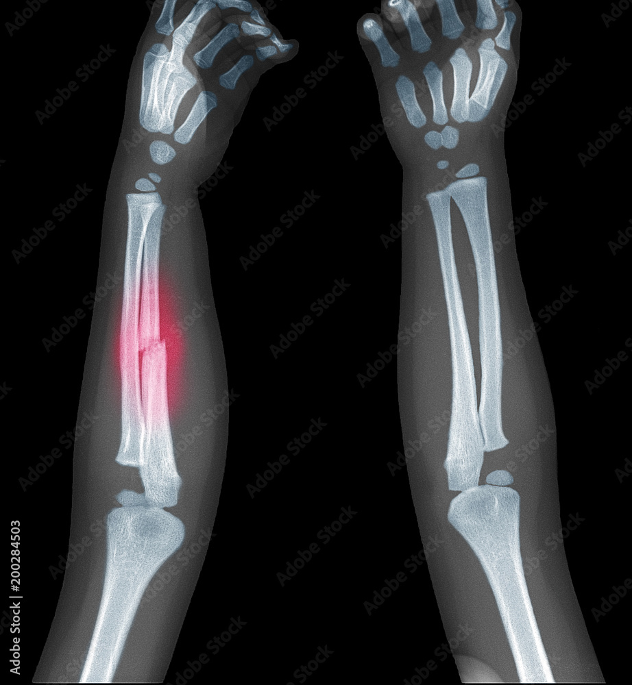 Xray image of child's forearm show bone fracture at red mark. Stock