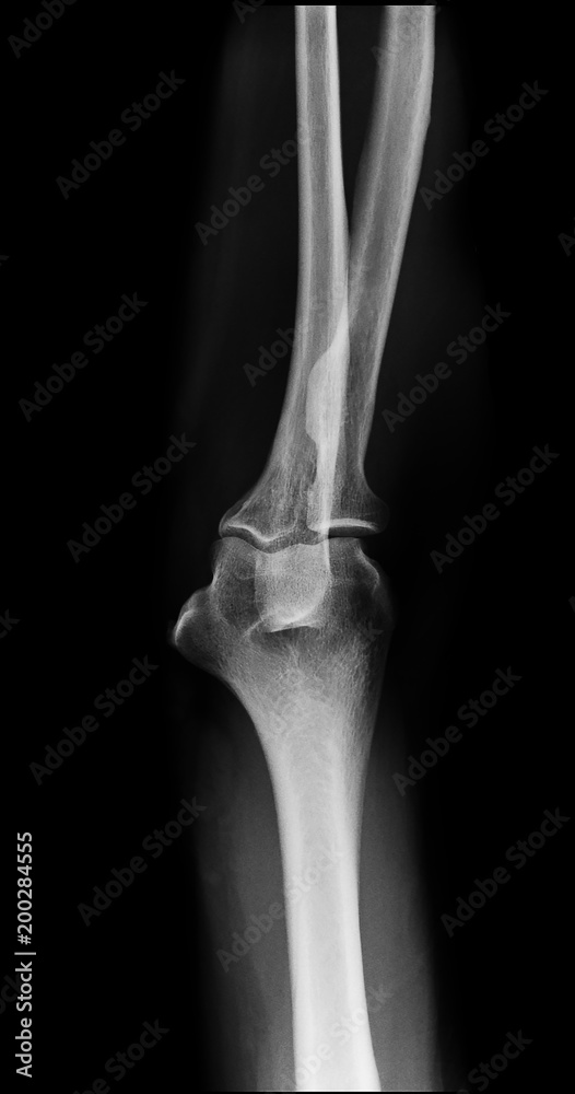 Naklejka premium normal elbow x-ray front view