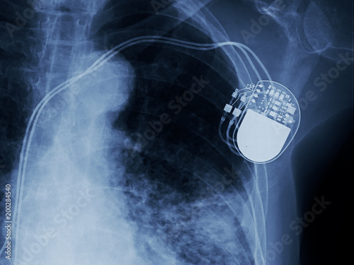 x-ray image of permanent pacemaker implant in chest body , process in blue tone photo
