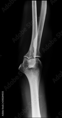 normal elbow x-ray front view