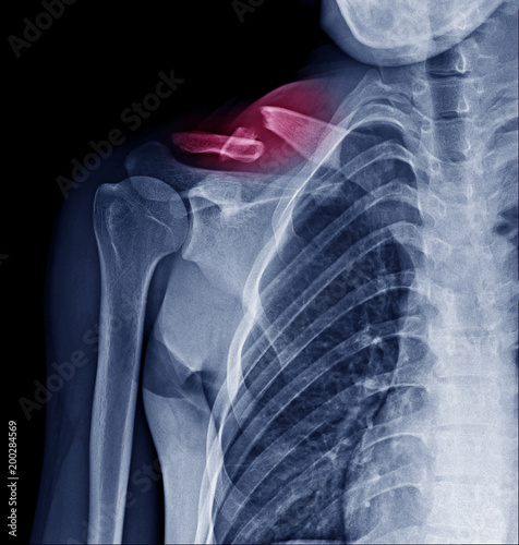 X Ray image of fracture clavicle at red mark area