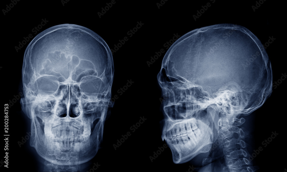 Very good quality X-ray image of normal human skull front (AP) view and side (Lateral) view, Process in blue tone isolated on black background. Very good quality X-ray image of normal human skull front (AP) view and side (Lateral) view, Process in blue tone isolated on black background.