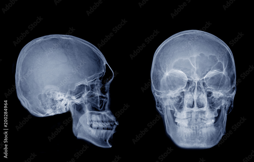 Very good quality X-ray image of normal human skull front (AP) view and side (Lateral) view, Process in blue tone isolated on black background.