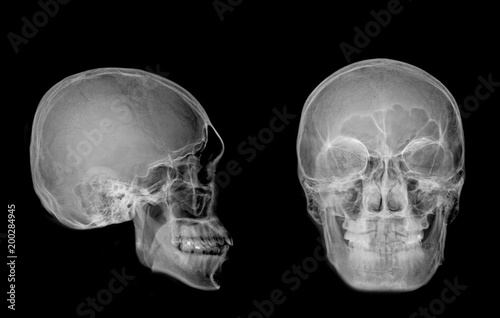 Very good quality X-ray image of normal human skull front (AP) view and side (Lateral) view, Process in normal tone isolated on black background.