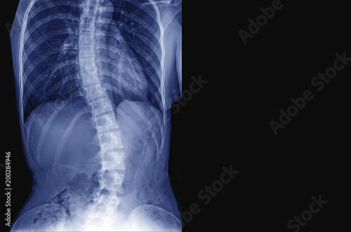 X-ray image of teenager patient spine show Scoliosis and spinal bend in young people. Process in blue tone and have copy space, Medical concept. photo