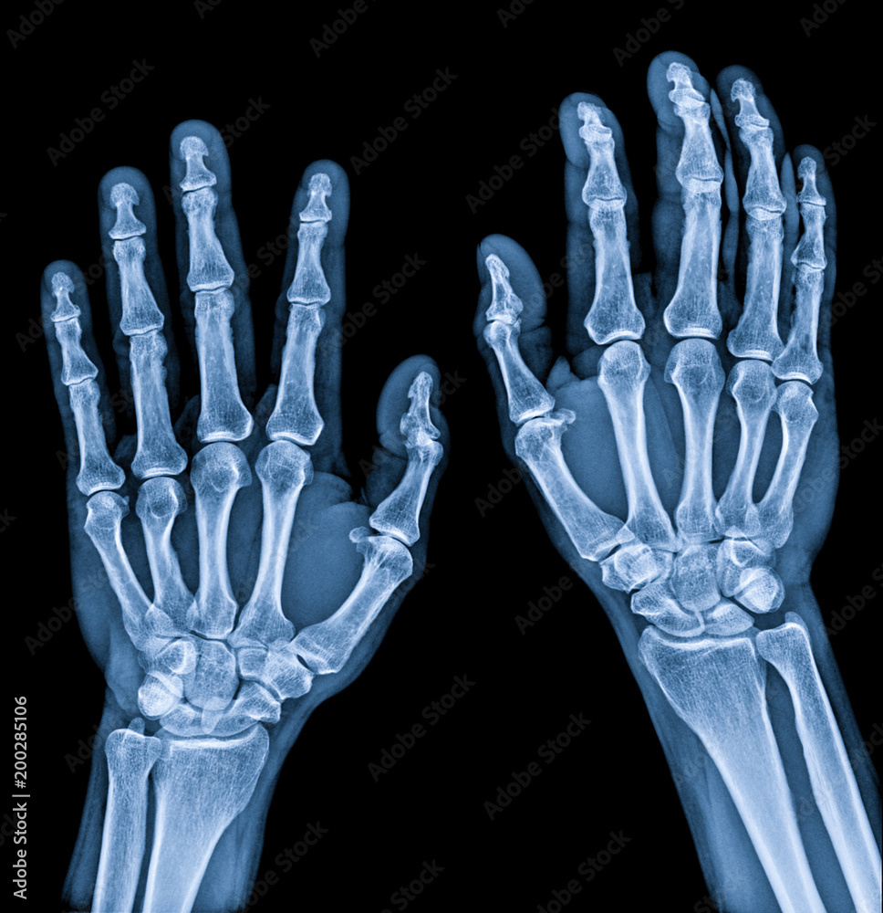Normal male Hand x-ray both side process in blue tone Normal male Hand x-ray both side process in blue tone