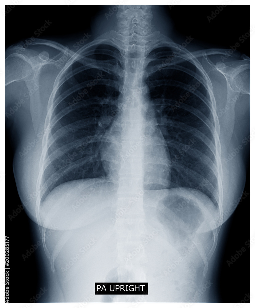 X-ray image of human body chest, very good quality X-ray image of human body chest, very good quality