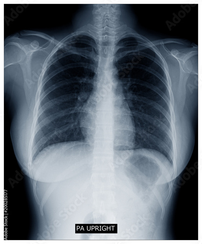 X-ray image of human body chest, very good quality photo