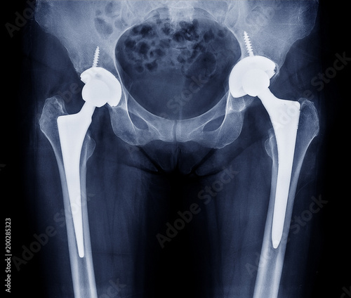 total hip replacement, osteoarthritis of hip joint , artificial hip joint, hip pain photo