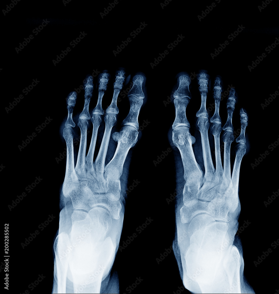 Xray image of normal foot both side Stock Photo Adobe Stock