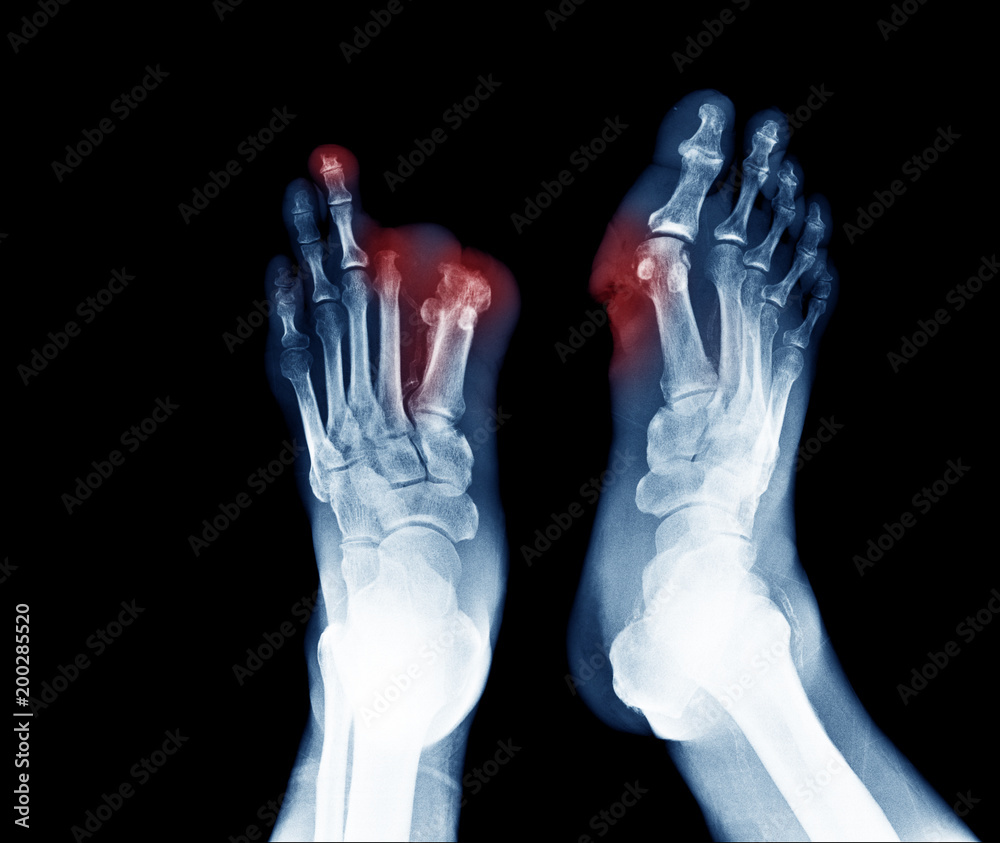 Xray image of diabetic foot ulcer show Joints Collapse and toes amputation Stock Photo Adobe Stock