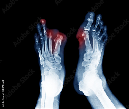 Xray image of diabetic foot ulcer show Joints Collapse and toes amputation