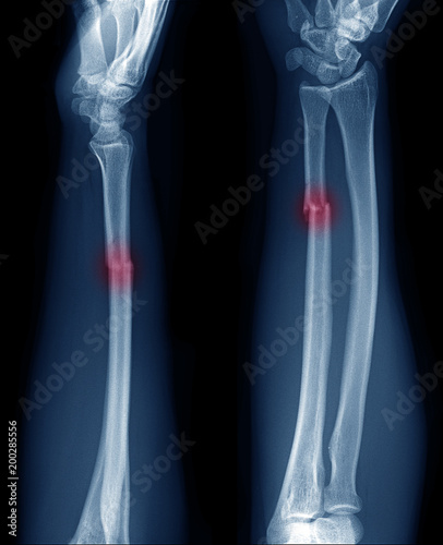 X-ray image of Forearm bone fracture in child's (Radius bone, Ulna bone)  Stock Photo | Adobe Stock